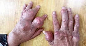 高尿酸血症与痛风