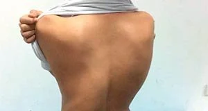 脊柱关节炎