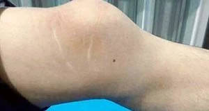 风湿性关节炎