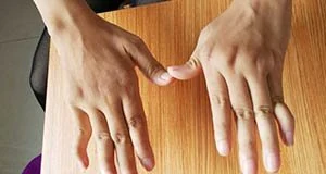 类风湿性关节炎