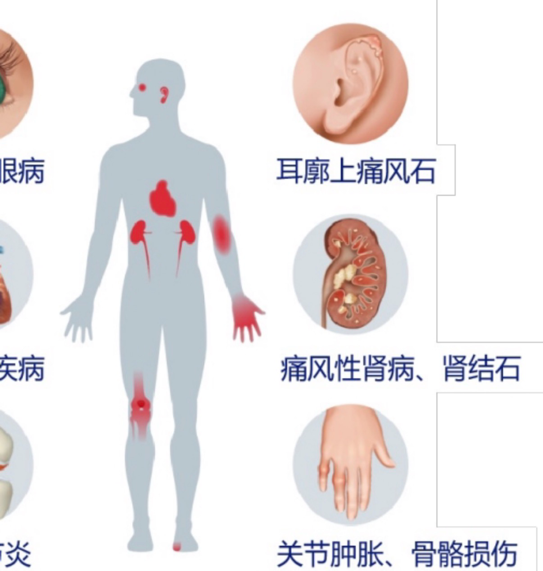 高尿酸全身性慢病
